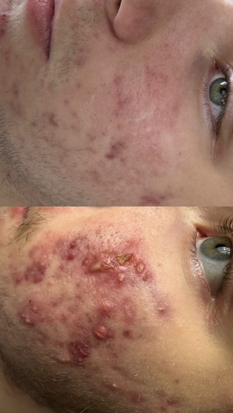 Лікування акне