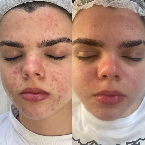 Лікування акне