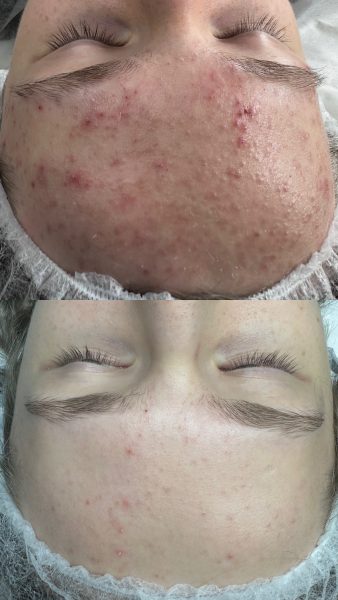 Лікування акне