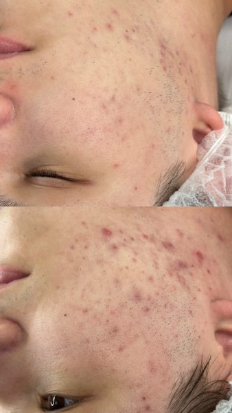 Лікування акне