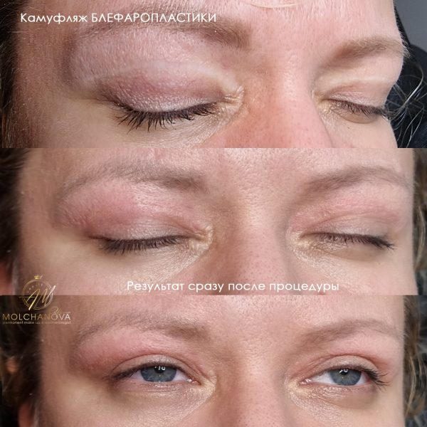 Медичний естетичний камуфляж тіла