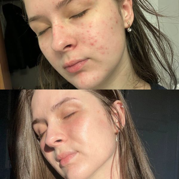 Лікування акне