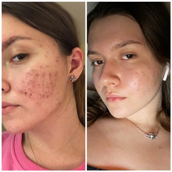 Лікування акне