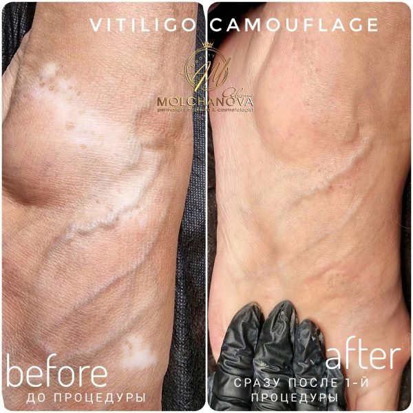 Медичний естетичний камуфляж тіла