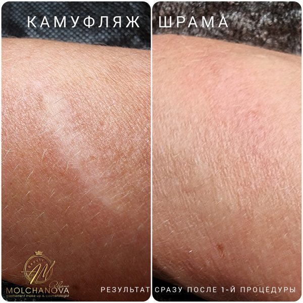 Медичний естетичний камуфляж тіла