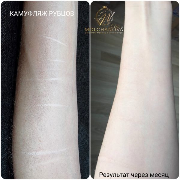 Медичний естетичний камуфляж тіла