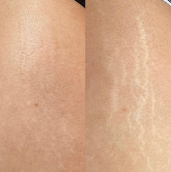 Медичний естетичний камуфляж тіла