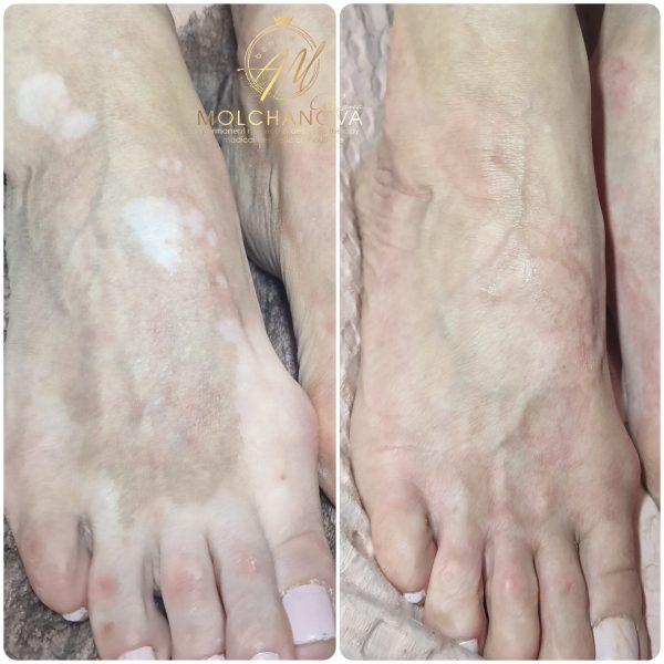 Медичний естетичний камуфляж тіла