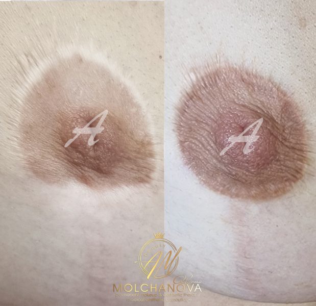 Медичний естетичний камуфляж тіла