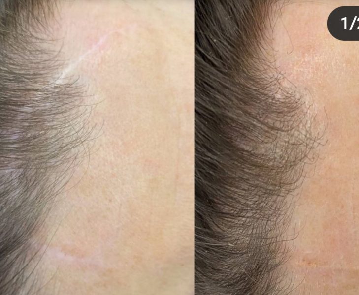 Медичний естетичний камуфляж тіла