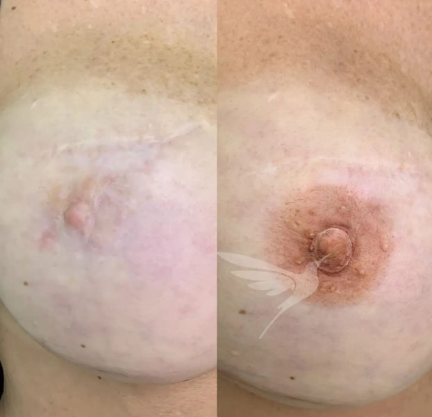 Медичний естетичний камуфляж тіла